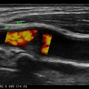 ﻿무증상 우측 외경동맥 기시부 협착, moderate stenosis. 이미지