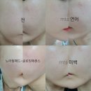 피엘케이엘케이 줄기세포 피부관리