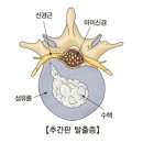 디스크(요추 추간판 탈출증 ) 이미지