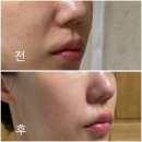 정보은헤어 | [대치역피부과] 쥬베룩 볼륨 1회차 후기(효과, 부작용, 가격)
