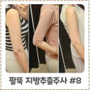 팔뚝살빼는법 지방추출주사 두달차 후기 옷핏 달라진 이유
