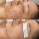 지니메디칼 | [어나더핸드] 논현역 신부 피부장벽관리, 예민한 피부도 자극 없이 어나더부스트먼트 후기