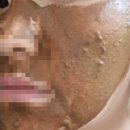 백강초등학교 | 피부과기미치료 효과후기 장희빈미안법