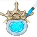 우리들신경외과의원 | 목디스크 대학병원? 강남신경외과? 현직 의사가 선택 기준 정리해 드립니다