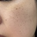 노화장 | 영등포 루비레이저, 듀얼토닝 내돈내산 솔직후기(기미, 주근깨, 부작용)