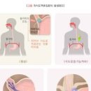 명치가슴통증 유발 역류성식도염 원인은 이미지