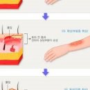 1도 2도 3도 단계 화상 입었을때 뜨거운물 저온 기름 통증 연고 응급처치 종합정리 이미지