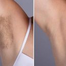 메이더왁싱(May The Waxing) | 상암동피부과 레이저제모, 여성이 가장 만족한 시술 부위 TOP3