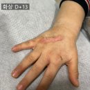 복재선생집 | [화상 치료 후기-4] 유아 심재성 2도 화상 1-2개월 경과, 흉터 치료, 실비 보험, 안양 군포 평촌 화상...