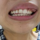 [강동] 송파치아미백 코랄치과 치아미백 &amp; 이시림 증상 일주일 후기 (치아미백 부작용, 지속기간)