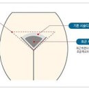 [무모,빈모모발이식] 무모증 모발이식 후 주의할 사항및 관리법# 여성무모,빈모증 고민무료상담 이미지