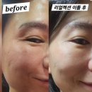 킬러짐 | [압구정로데오병원]리얼젝션 잔주름킬러 시술 후기