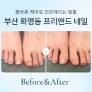 케어로 | 부산 발톱무좀 올바른 케어로 나아진 후기