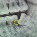 뽑다 | [사랑니 발치 후기] 매복 사랑니 부셔서 뽑다 (식사, 빨대, 통증 기간 총정리)