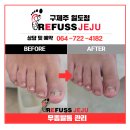 더화인마트 | [제주무좀발톱] 샌들 신기 부담스러웠던 발톱 미국 고객님 레푸스제주에서 발관리 후기