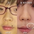 싸다go | 청주 점 제거 후기 (4회차, 입술 위 깊은 점)