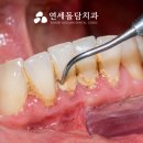 스케일링 덜아프게 받는법 비용 명동 치과