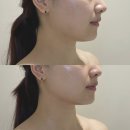 리파인 더 핏 | 청주웨딩관리 더리파인 얼굴라인 정리 후기