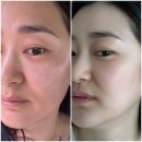 필스토리의원 | 전주 서신동 필스토리의원ㅣ 쿨페이즈600샷 효과 후기 (써마지 차이, 부작용, 통증, 주의사항)