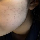 수원중학생여드름, 청소년여드름 치료 잘하는 곳 솔직 후기