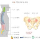 특정관절병∙척추염 진단비 특별약관[강직성 척추염, 백색포도균 척추염, 외상, 결핵] 이미지