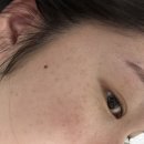 금평초 | 전주 주근깨레이저 (엑셀V레이저) 후기