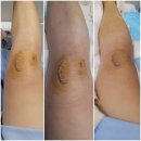 경남의료기상사 | 창원 메트로병원 무릎인대수술과 입원 기록