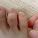 내돈내산 라셀턴 문제성발톱 앰플