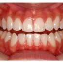 치아미백비용 누런 치아의 치아미백을 통한 해결 (치아미백비용.치아미백가격) 이미지