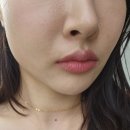 강남피부과 국산울써티 볼링크4D리프팅후기 내돈내산 전후사진비교