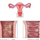 칸디다 질염 증상 분비물 가려움 통증 원인 치료 예방방법 이미지