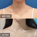 스페이스피부과의원 | [강남 피부과 추천] 예비신부 관리로 유명한 승모근 보톡스 후기! 어깨라인 심폐소생하고 온 솔직 이야기