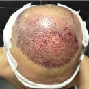 장인이발가발이용원 | 가발벗고 터키에서 모발이식받은 후기.