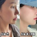 청담동피부과 온다리프팅 8만줄 유지기간 및 효과 내돈내산 후기