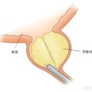 전립선 비대증 이미지