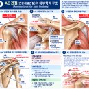 AC 관절 통증과 손상 테이핑｜견봉쇄골관절을 어떻게 지지할까요? 이미지