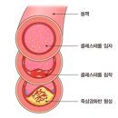 뇌졸중 (Cerebrovascular disease)의 원인과 치료 이미지