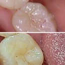 설 치과기공소 네이버블로그