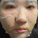 메디스코 | 메디스코 해초필링 3회차 필링 후기 트러블 홈케어