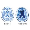 한국디비티센터(DBTCenterofKorea) | 뇌, 안녕들 하십니까..세계는 지금 치매와의 전쟁 중