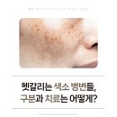 고운세상피부과의원 서부산점 | 명지피부과 에서 알려드리는 기미, 흑자, 검버섯 구분하는 법!