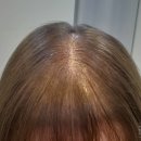 [마이크로헤어] 서울 송파구 20대 여자 탈모 독보적인 증모술 후기