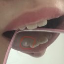 반도치과의원 | 앞니 신경치료 후 크라운 씌우기 싫어서 레진으로 떼움