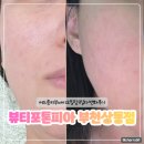 상동프라자 | 부천여드름관리 상동문제성피부관리 잘하는 곳 뷰티포톤피아 바이오필링 후기