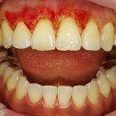 하늘정원치과의원 | 강서구 거미스마일, 잇몸성형, 멜라닌색소 제거 후기