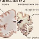 알츠하이머병[alzheimer&#39;s disease] 이미지