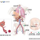 악성골종양 이미지