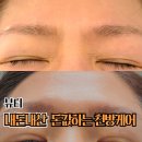 누야그 | 천방케어 내돈내산 후기 (통증, 가격, 주의사항) - 40대 후반부터는 꼭 해야 할 이유