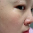 압구정약국 | 주근깨잡티고민 루비레이저로 해결했어요(압구정기미잡티제거병원성지)1520방맞은 내돈내산후기