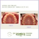 즐거운연세치과의원 | 연세라벤더치과 "2월 비발치교정 (치아겹침, 반대교합 비수술)"후기
